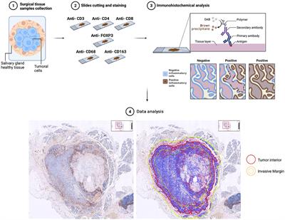 Tumor-infiltrating lymphocytes and tumor-associated macrophages as potential predictors of lymph node metastases in major salivary gland cancers